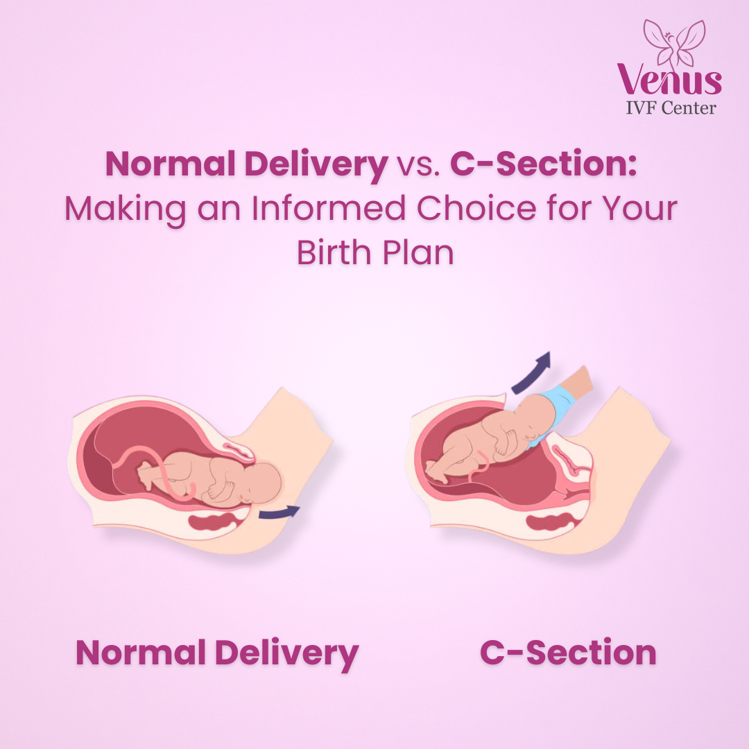 Normal Delivery vs. C-Section: Making an Informed Choice for Your Birth Plan